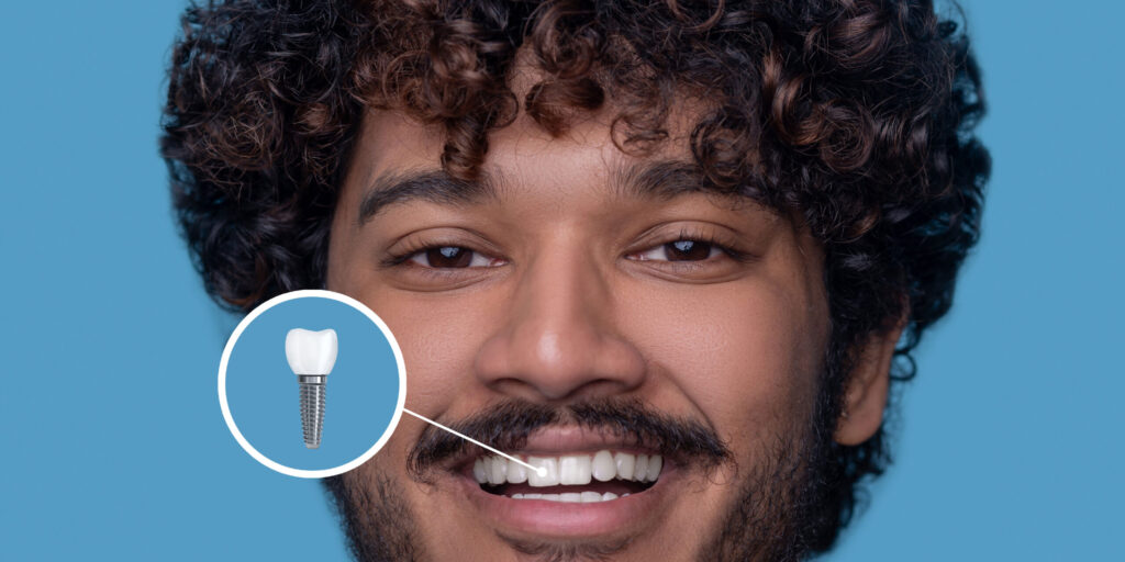 Dental Implants: Cost Efficient Treatment For Enhanced Smile